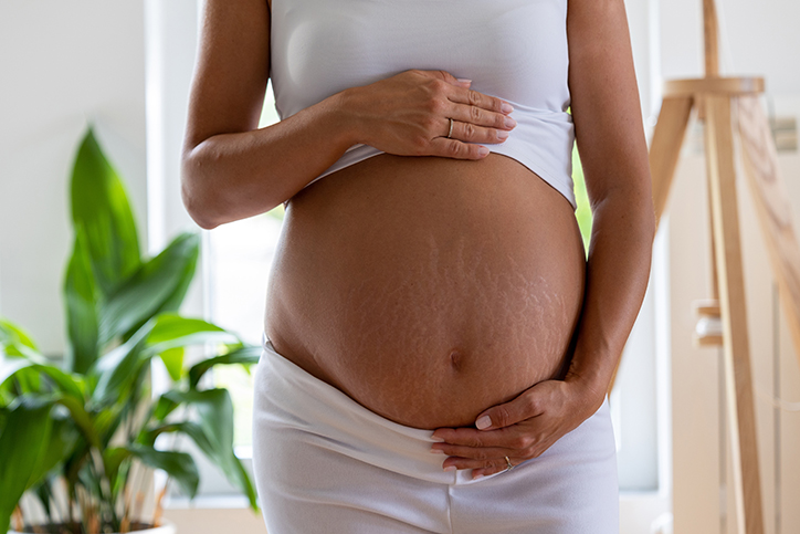 Estrias na gravidez: como tratar?